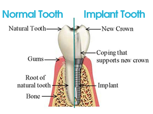 Dental Implant Doncaster